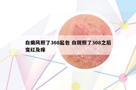 白癜风照了308起包 白斑照了308之后变红及痒