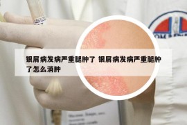 银屑病发病严重腿肿了 银屑病发病严重腿肿了怎么消肿