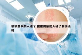 被银屑病的人碰了 被银屑病的人碰了会传染吗