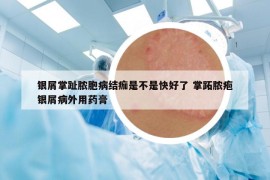 银屑掌趾脓胞病结痂是不是快好了 掌跖脓疱银屑病外用药膏