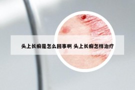 头上长癣是怎么回事啊 头上长癣怎样治疗