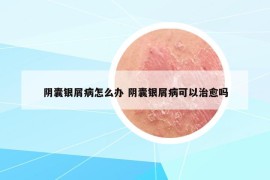 阴囊银屑病怎么办 阴囊银屑病可以治愈吗