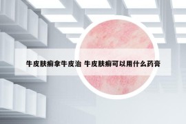 牛皮肤癣拿牛皮治 牛皮肤癣可以用什么药膏