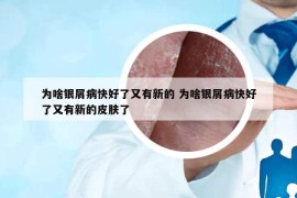 为啥银屑病快好了又有新的 为啥银屑病快好了又有新的皮肤了