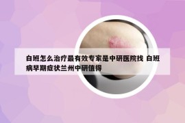 白班怎么治疗最有效专家是中研医院找 白班病早期症状兰州中研值得