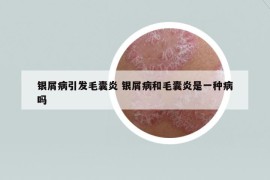 银屑病引发毛囊炎 银屑病和毛囊炎是一种病吗