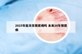 2025年能攻克银屑病吗 未来20年银屑病