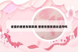 老婆的爸爸有银屑病 爸爸有银屑病会遗传吗