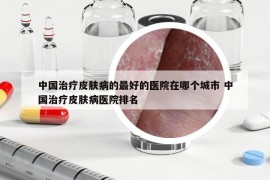 中国治疗皮肤病的最好的医院在哪个城市 中国治疗皮肤病医院排名