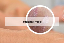 牛皮癣病治疗方法