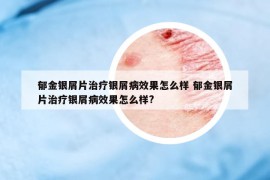 郁金银屑片治疗银屑病效果怎么样 郁金银屑片治疗银屑病效果怎么样?