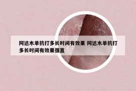 阿达木单抗打多长时间有效果 阿达木单抗打多长时间有效果强直