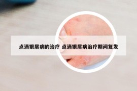 点滴银屑病的治疗 点滴银屑病治疗期间复发