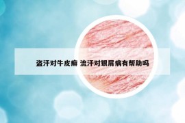 盗汗对牛皮癣 流汗对银屑病有帮助吗