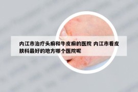 内江市治疗头癣和牛皮癣的医院 内江市看皮肤科最好的地方哪个医院呢