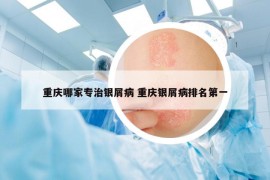 重庆哪家专治银屑病 重庆银屑病排名第一