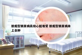 脓疱型银屑病高烧心脏难受 脓疱型银屑病身上会肿