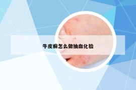 牛皮癣怎么做抽血化验