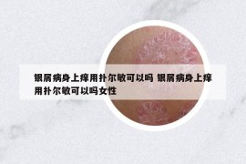 银屑病身上痒用扑尔敏可以吗 银屑病身上痒用扑尔敏可以吗女性