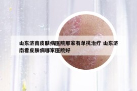 山东济南皮肤病医院那家有单抗治疗 山东济南看皮肤病哪家医院好