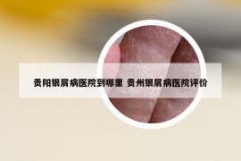 贵阳银屑病医院到哪里 贵州银屑病医院评价