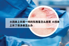 小孩身上长癣一样的东西是怎么回事 小孩身上长了很多癣怎么办