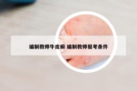 编制教师牛皮癣 编制教师报考条件