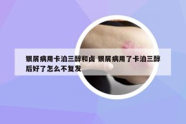 银屑病用卡泊三醇和卤 银屑病用了卡泊三醇后好了怎么不复发