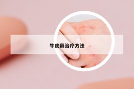 牛皮藓治疗方法