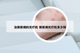 治银屑病的光疗机 银屑病光疗机多少钱