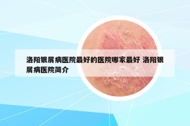 洛阳银屑病医院最好的医院哪家最好 洛阳银屑病医院简介