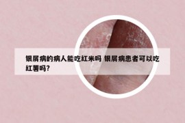 银屑病的病人能吃红米吗 银屑病患者可以吃红薯吗?