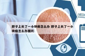 脖子上长了一小块癣怎么办 脖子上长了一小块癣怎么办图片