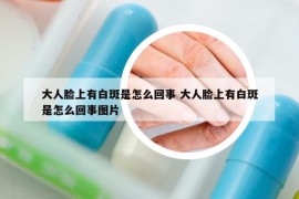 大人脸上有白斑是怎么回事 大人脸上有白斑是怎么回事图片