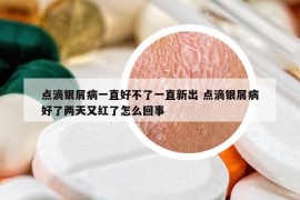 点滴银屑病一直好不了一直新出 点滴银屑病好了两天又红了怎么回事