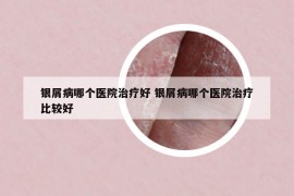 银屑病哪个医院治疗好 银屑病哪个医院治疗比较好