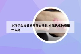 小孩子头皮长癣用什么洗头 小孩头皮长癣用什么药