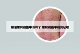 脓包银屑病指甲没有了 银屑病指甲病变起脓