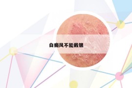 白癜风不能戴银