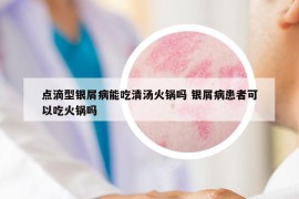 点滴型银屑病能吃清汤火锅吗 银屑病患者可以吃火锅吗