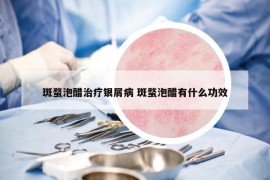 斑蝥泡醋治疗银屑病 斑蝥泡醋有什么功效