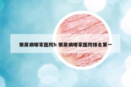 银屑病哪家医院h 银屑病哪家医院排名第一