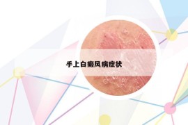 手上白癜风病症状