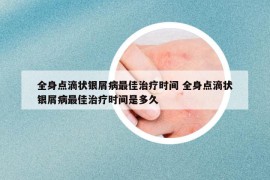 全身点滴状银屑病最佳治疗时间 全身点滴状银屑病最佳治疗时间是多久