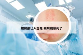 银屑病让人想死 银屑病烦死了