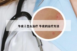 牛皮廯怎么治疗 牛皮的冶疗方法