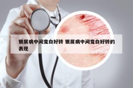 银屑病中间变白好转 银屑病中间变白好转的表现