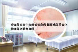 查血能查出牛皮癣关节炎吗 银屑病关节炎化验血能化验出来吗