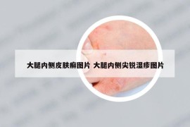 大腿内侧皮肤癣图片 大腿内侧尖锐湿疹图片