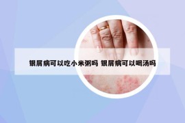 银屑病可以吃小米粥吗 银屑病可以喝汤吗